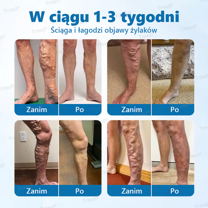 Trimil® Ziołowy Spray na Ochronę Żył -🎯 Klinicznie udowodniono, że eliminuje żylaki w zaledwie 7 dni!